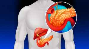 Read more about the article Acute Pancreatitis: Do not ignore the Sudden Pain in the Abdomen