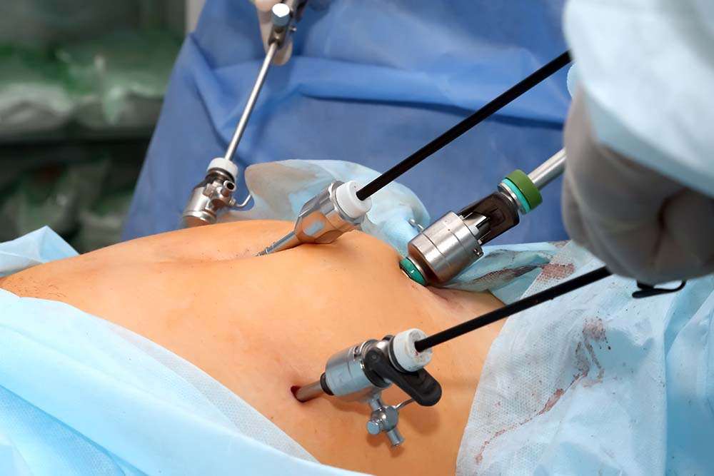 Read more about the article Is Laparoscopic Surgery Better Than Open Surgery?