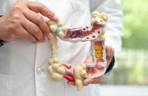 Read more about the article Colon Polyps: Are They Cancerous and When to Remove Them?