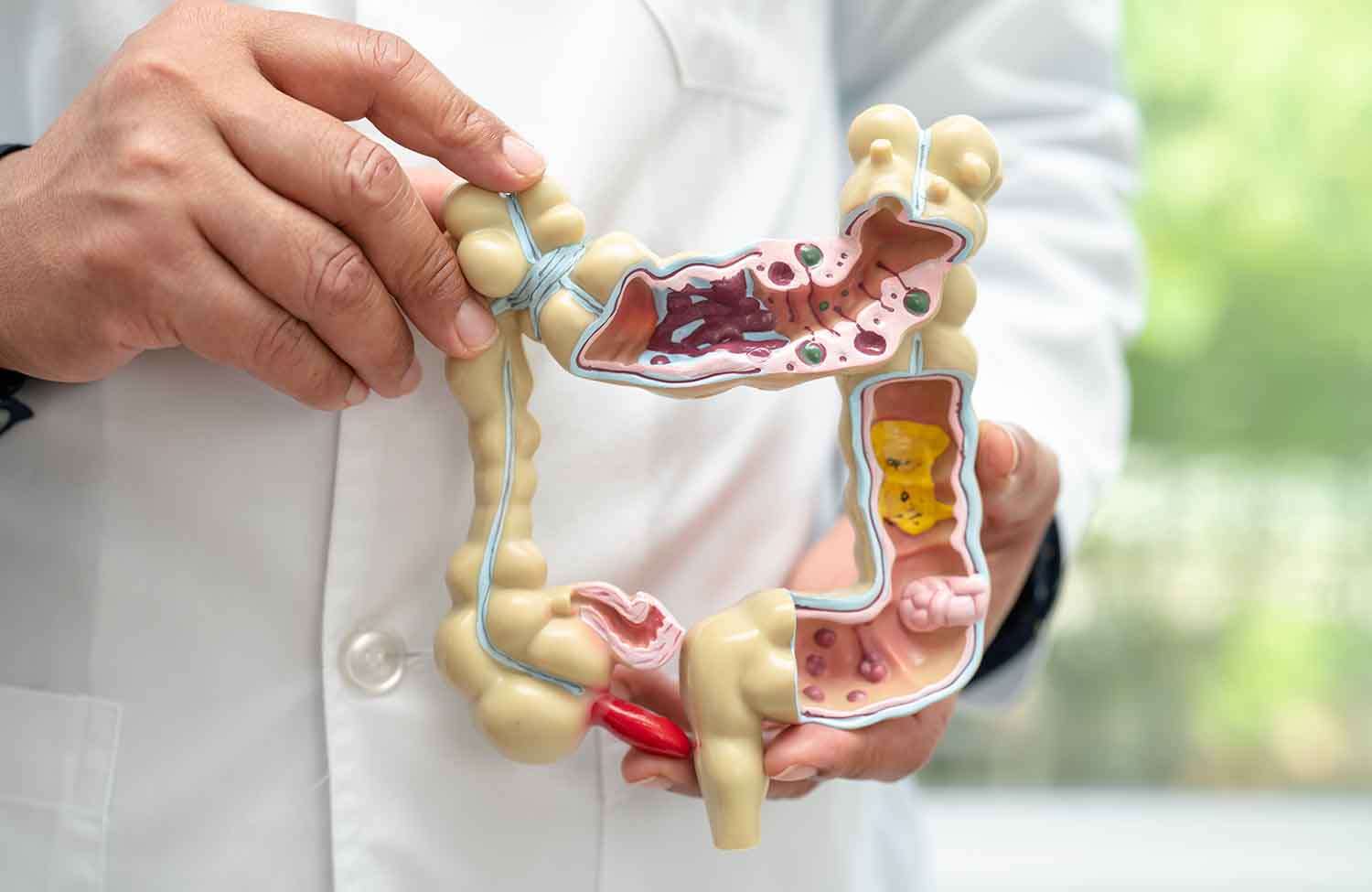 You are currently viewing Colon Polyps: Are They Cancerous and When to Remove Them?