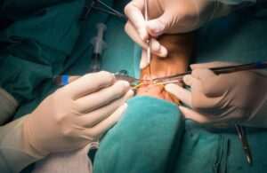 Read more about the article Enterocutaneous Fistula: Complex Surgery & Long-Term Care Explained