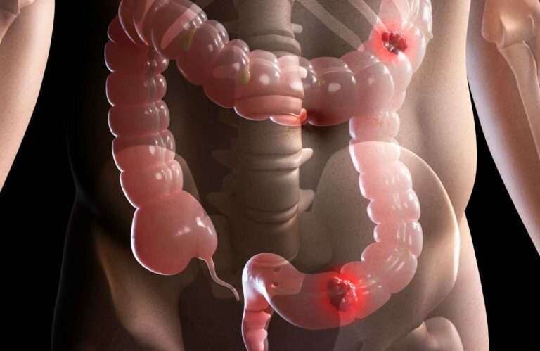 Life After Colorectal Cancer Surgery: A Guide From The Best Colorectal Surgeon In Surat