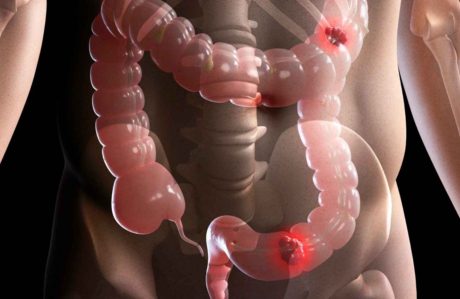 You are currently viewing Life After Colorectal Cancer Surgery: A Guide From The Best Colorectal Surgeon In Surat